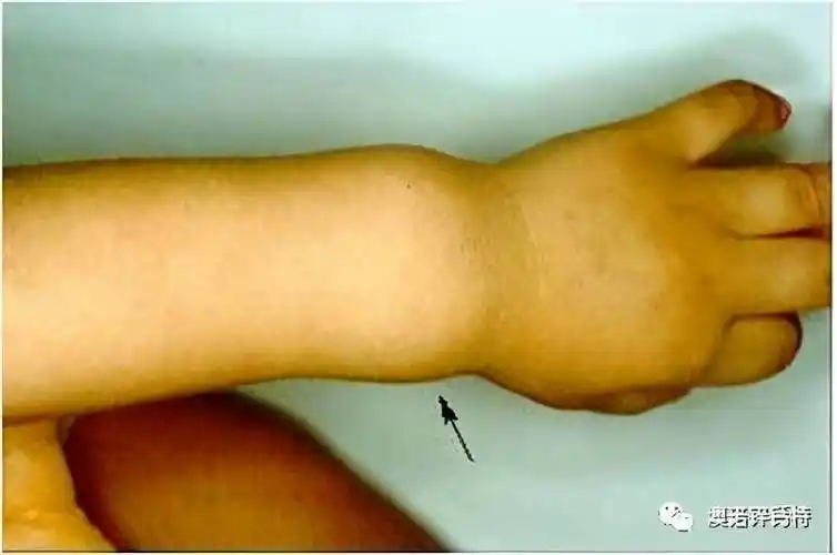 佝偻病的症状佝偻病的症状和临床特点