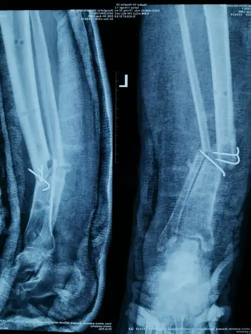 左小腿开放骨折术后感染一例