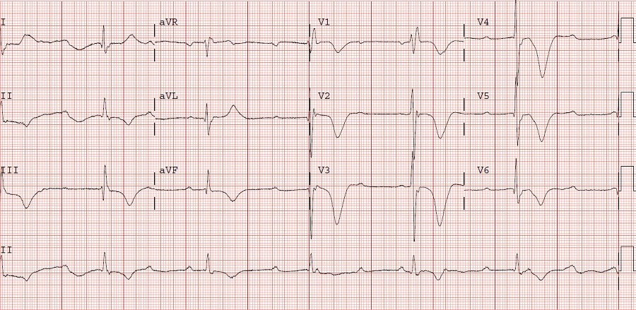 一问一答心电图报告上的t波倒置是什么意思