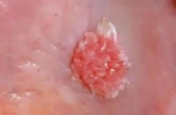 菜花状尖锐疣是高危病毒吗