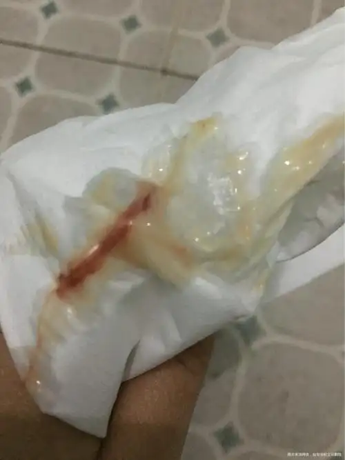 谁有过排卵期出血的