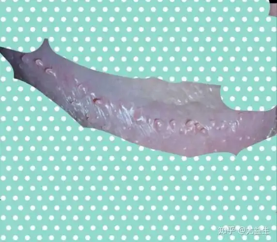 假性湿疣之男性珍珠样丘疹,可私信图片,帮您看一下.