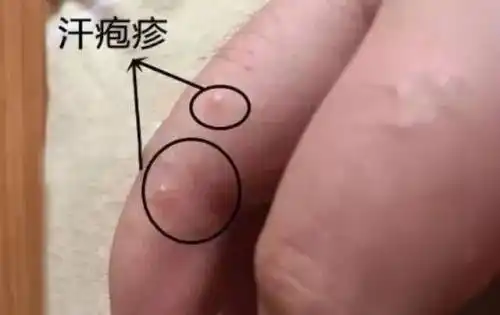 如何辨别湿疹和汗疱疹