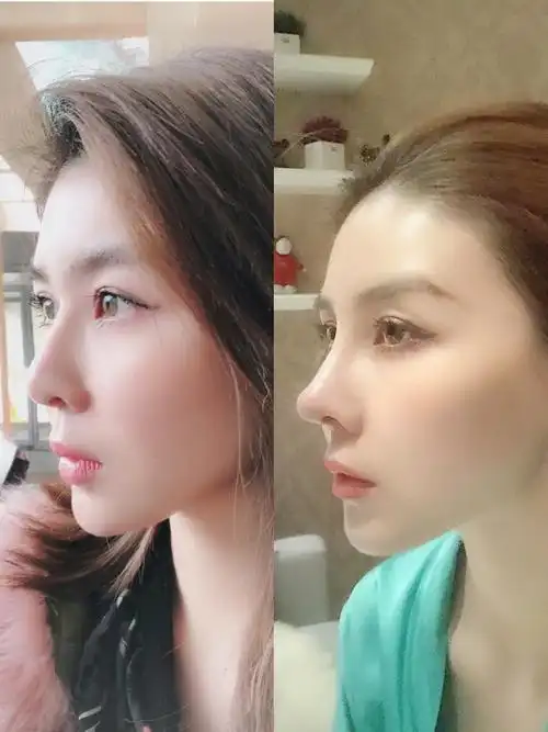 两次隆鼻,第二次耳软骨小鼻综合术后分享0505 术前:六年前做过
