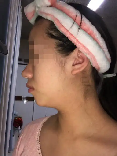 请问我这个是嘴凸还是下巴后缩啊矫正牙齿能起作用吗还是说得做反颌