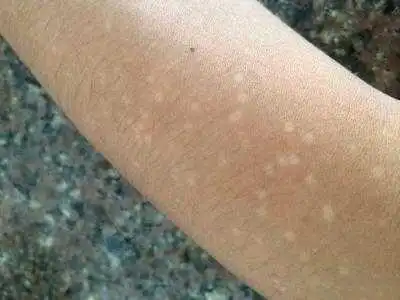 白色糠疹的症状表现白色糠疹的症状表现是什么