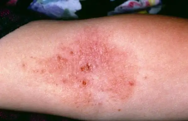 自身继发性的感染;一种是渗液接触到别人的皮肤,使别人出现病毒性感染