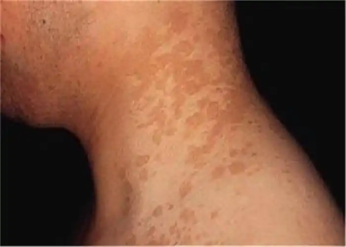 花斑癣男性的脖子上的大面积症状图片