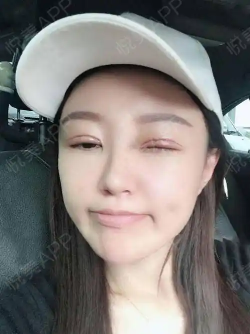 做双眼皮的第7天完全不影响自己的正常生活原本以为会肿得特别的夸张