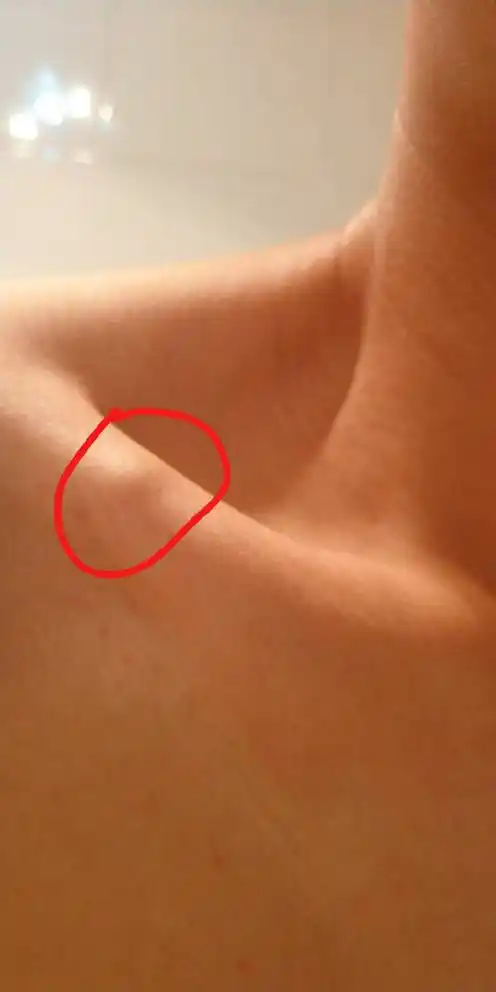 一个月扁桃体右侧化脓三次,颈部淋巴结肿大,右锁骨有个肿块.