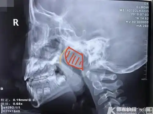 腺样体肥大,肥大的腺样体阻塞90%以上气道