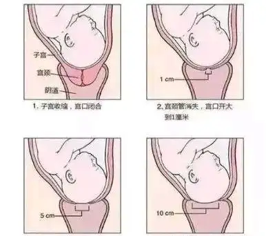 当分娩的信号来临,随着子宫的阵发性收缩,宫颈逐渐软化,缩短直至消失