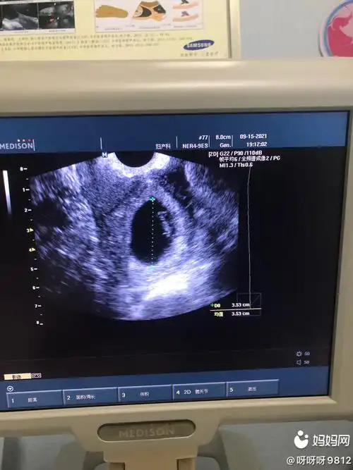 七周加一的宝宝,孕囊看男女准吗