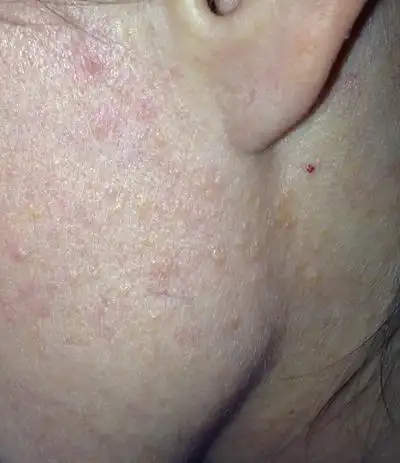 橘皮样皮肤图片45