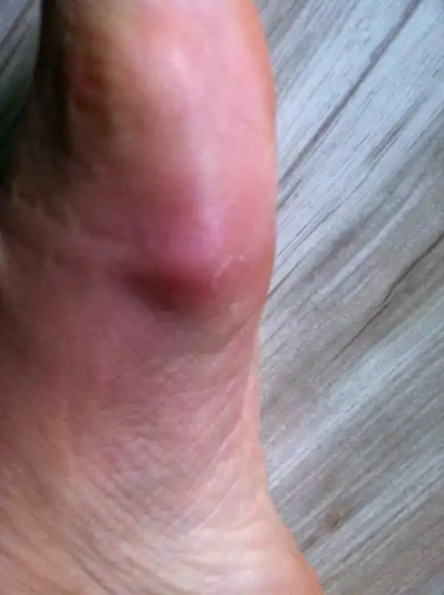 您好,我的脚被钉子扎了,一个月了,封口了,但是里面感觉有脓