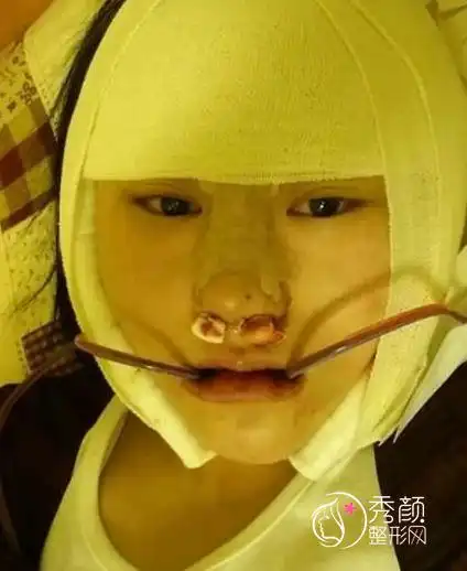 上海九院有磨骨失败案例吗_整形整容医院|微创手术