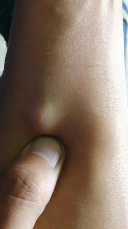 医师来自湖北省浠水县三店卫生院 答: 你的这种情况可能是皮下脂肪瘤