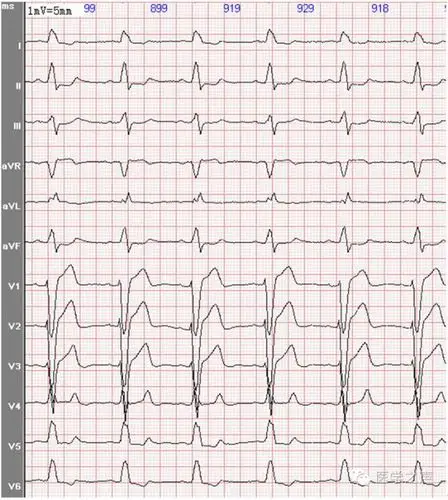 心电图课堂|第30期:完全左束支传导阻滞