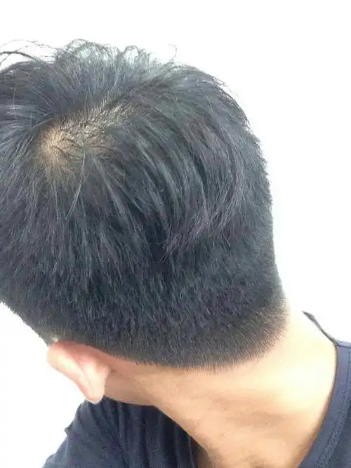 18岁男的秃顶了怎么办?原因是什么?要怎么治疗?