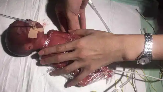 这个宝宝小名叫淘淘,在妈妈肚子里仅呆了24周 5天就出生了,医学上称之