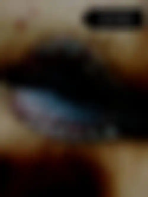 讨论:肛周湿疹是一种常见的非传染性皮肤病,病变多局限于肛门周围