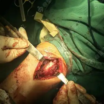 手术后诊断:左上臂脂肪瘤 病理诊断:- 手术:右上臂脂肪瘤切除术 手术