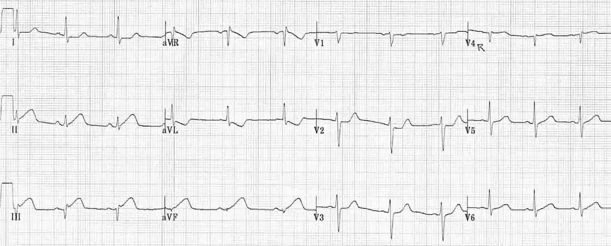 3种电轴左偏的心电图模式,你都见过吗?