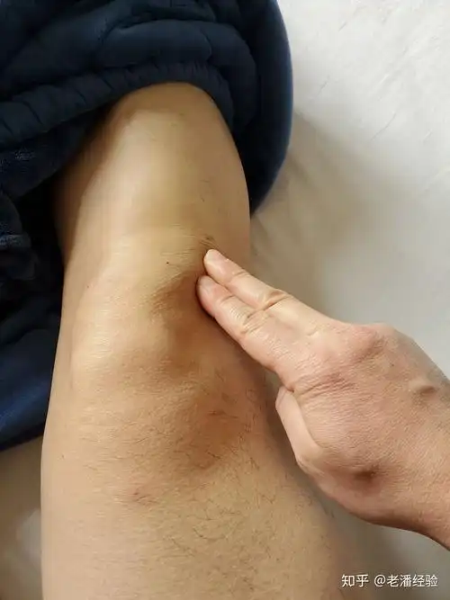 本人膝盖少量积液,想入行普拉提,膝盖积液,是否影响自己进入这一行 ?