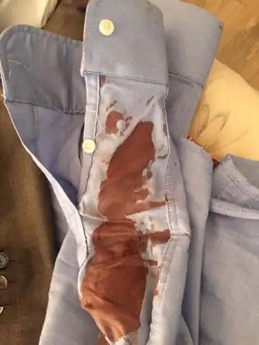 西服衬衫上沾了很多血渍,衣服隔了一夜,跪求怎么才能彻底洗掉,感谢!急