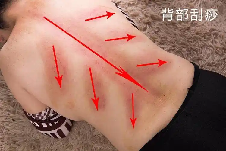 待丰富出痧形成深红色斑条即可不得来回刮动,每条大概刮20下刮痧时