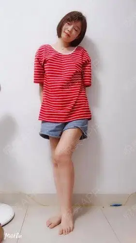 吸脂瘦全身术后13天_吸脂瘦大腿术后13天_自体脂肪