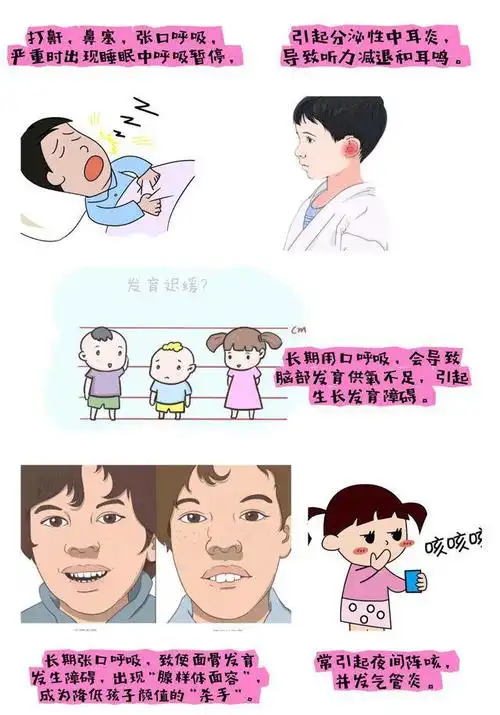 儿童腺样体肥大需警惕!