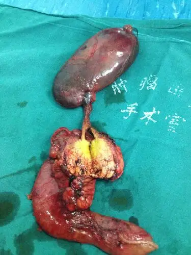 治疗胰腺癌的最佳手术方式--改良胰十二指肠切除术 - 好大夫在线