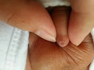 我家宝宝鸡鸡怎麼了?一尿尿就哭