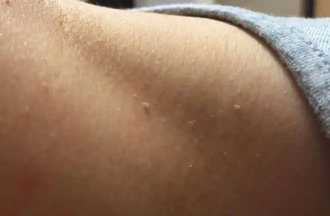 90后情侣下身双双长出菜花抠了又长医生早该来检查