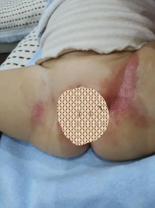 求宝妈看一下这个怎么了,是湿疹吗 - 百度宝宝知道