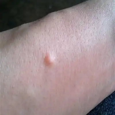 女性朋友注意了身上长出这样的疣体很有可能是hpv病毒趁早去检查