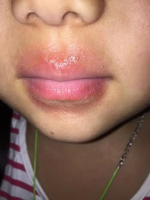 孩子的嘴唇这是怎么了?三天两头这样,这是病吗?刚给抹了点油