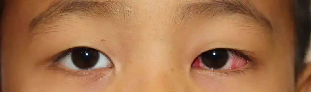 儿童眼病郭新教授西安限时坐诊手术,斜弱视等眼病患者速预约!