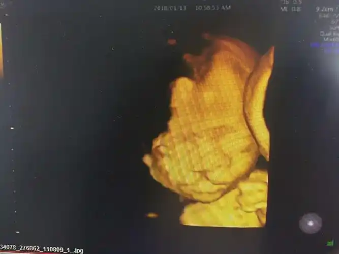 其它 扎赉特旗妇幼保健院彩超室 "gee8"四维彩超的引进,在妇产科领域