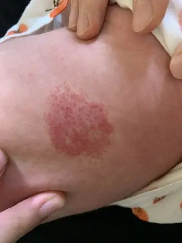 儿童血管瘤医学科普