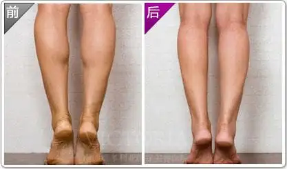 瘦腿