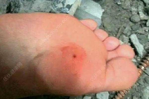 女子穿拖鞋晨跑脚底扎进生锈铁钉板若治疗不当有生命危险多图