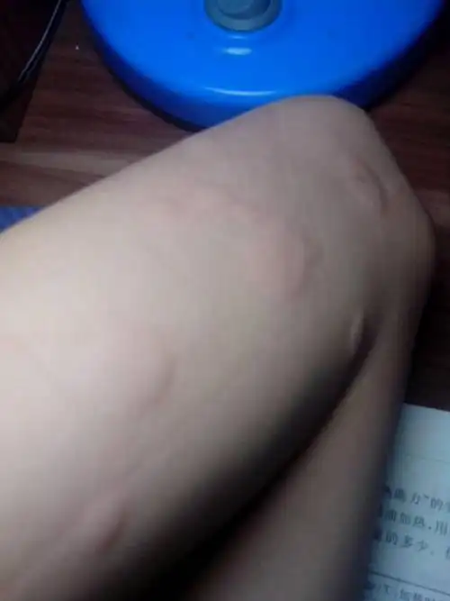 问:身上起疙瘩,每天晚上起,第二天早上差不多就下去了