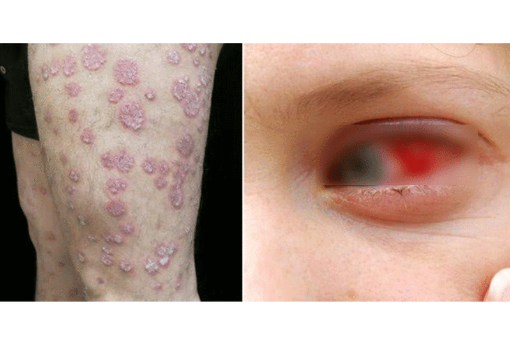 低温压力大重度干癣患者小心发生眼部葡萄膜炎