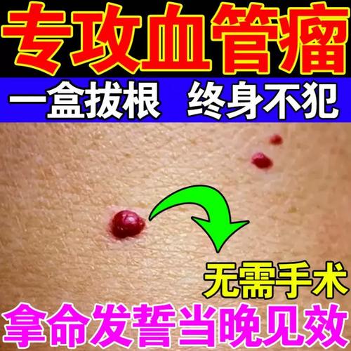 血管瘤用药膏血管痣去除婴儿x皮肤血管瘤樱桃草莓状瘤修复红血丝