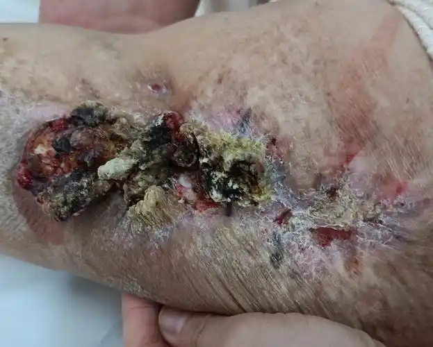 浅谈婴幼儿血管瘤