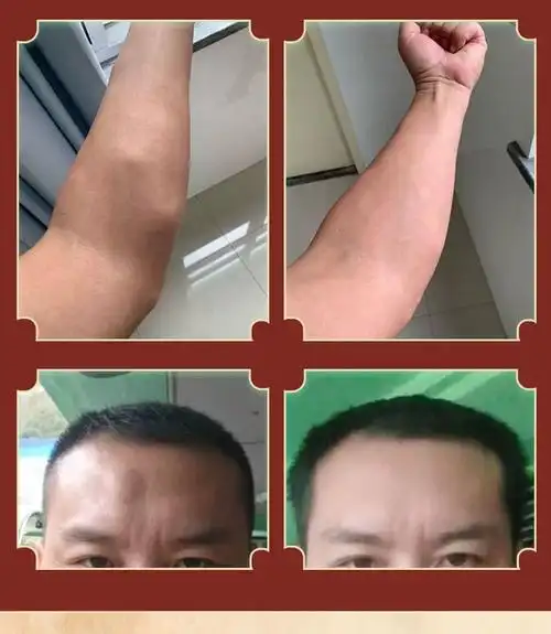 一贴见效脂肪瘤克星延安苏季善效万秋堂脂肪瘤去除膏消贴专用去除皮下