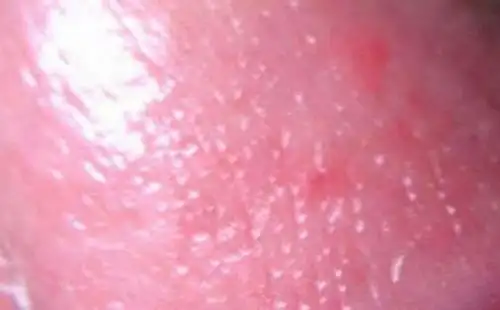 诊治性病中的一些误区