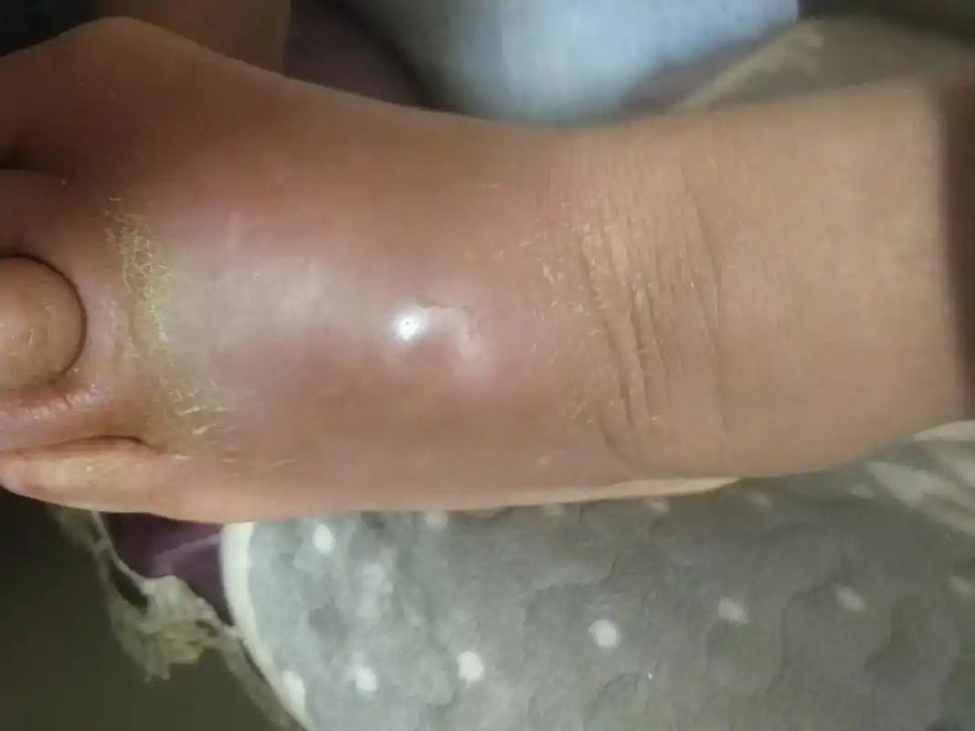 一觉醒来左脚肿的特别厉害,疼的 - 抖音